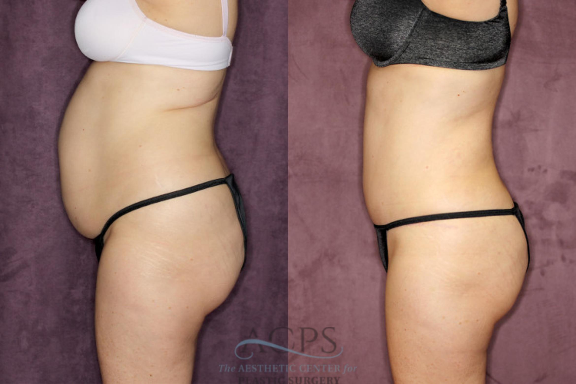 Before & After Liposuction Case 67 Side Left View: View in Houston, TX