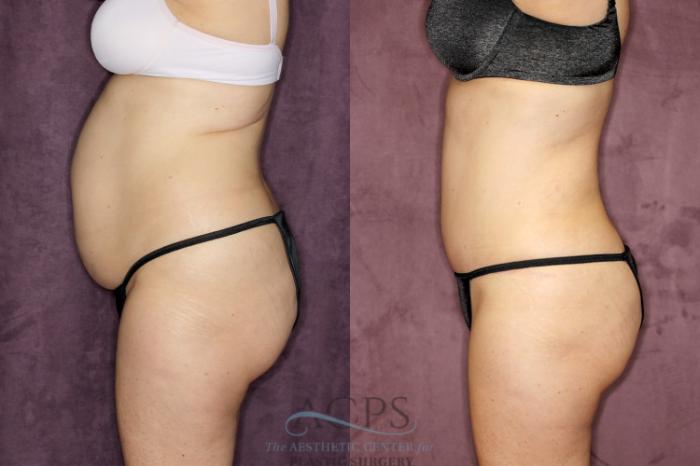Before & After Liposuction Case 67 Side Left View: View in Houston, TX