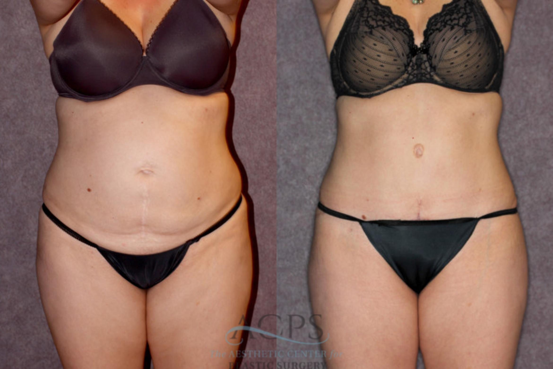 Before & After Tummy Tuck Case 68 Front View: View in Houston, TX