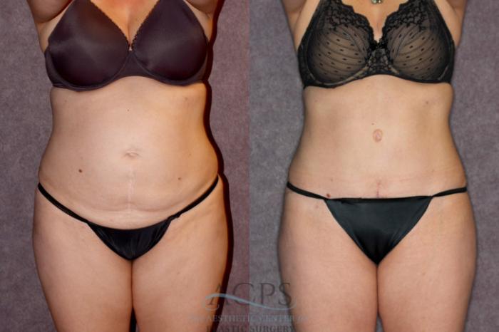 Before & After Tummy Tuck Case 68 Front View: View in Houston, TX