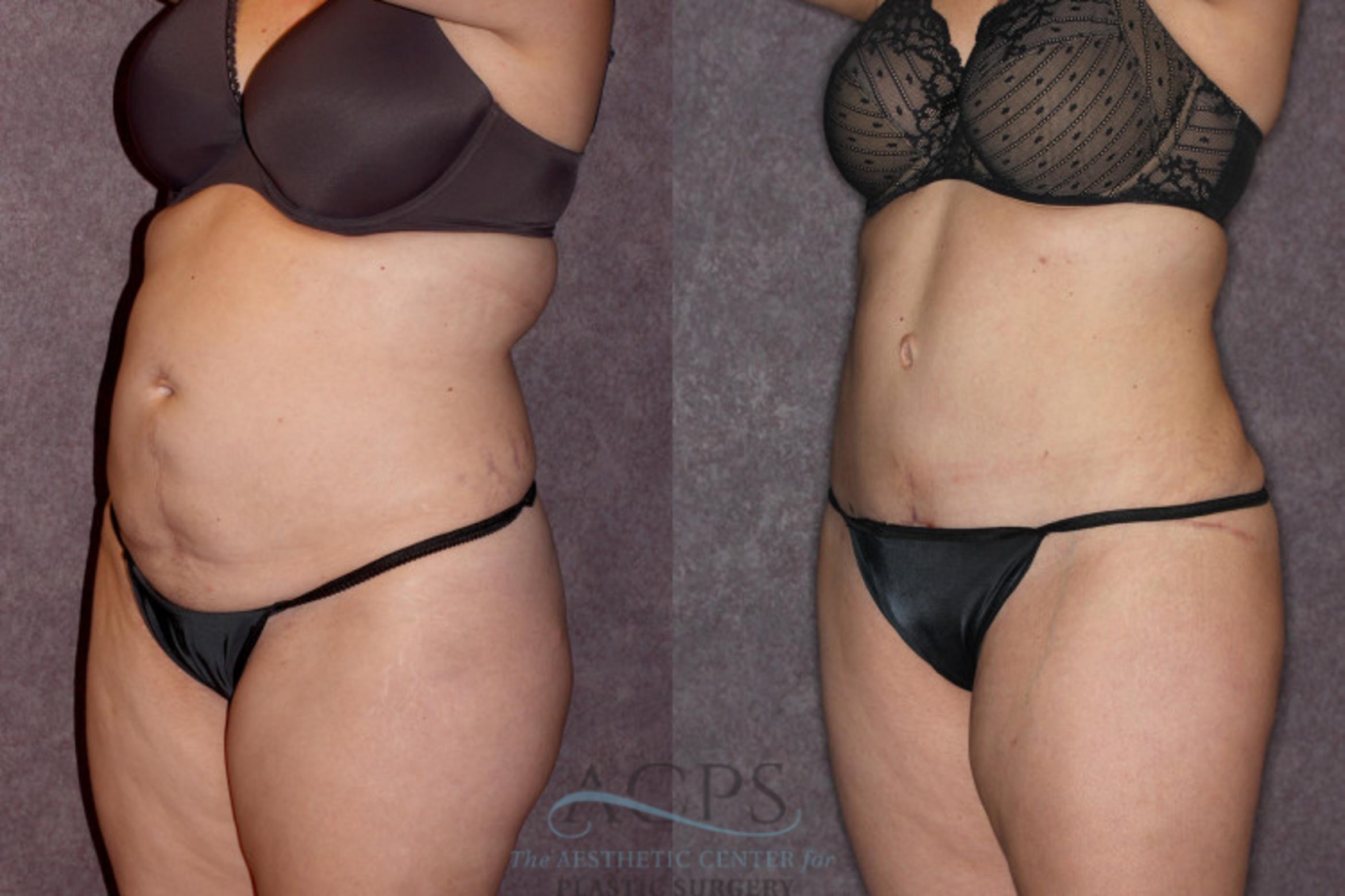 Before & After Tummy Tuck Case 68 Oblique Left View: View in Houston, TX