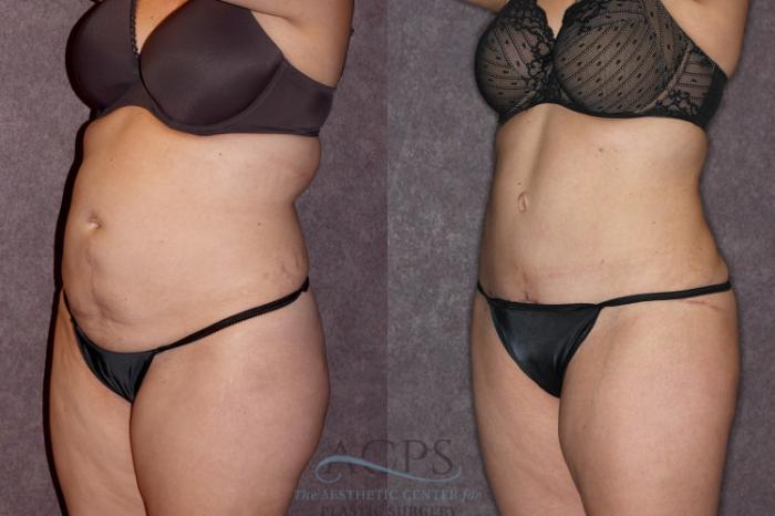 Before & After Tummy Tuck Case 68 Oblique Left View: View in Houston, TX