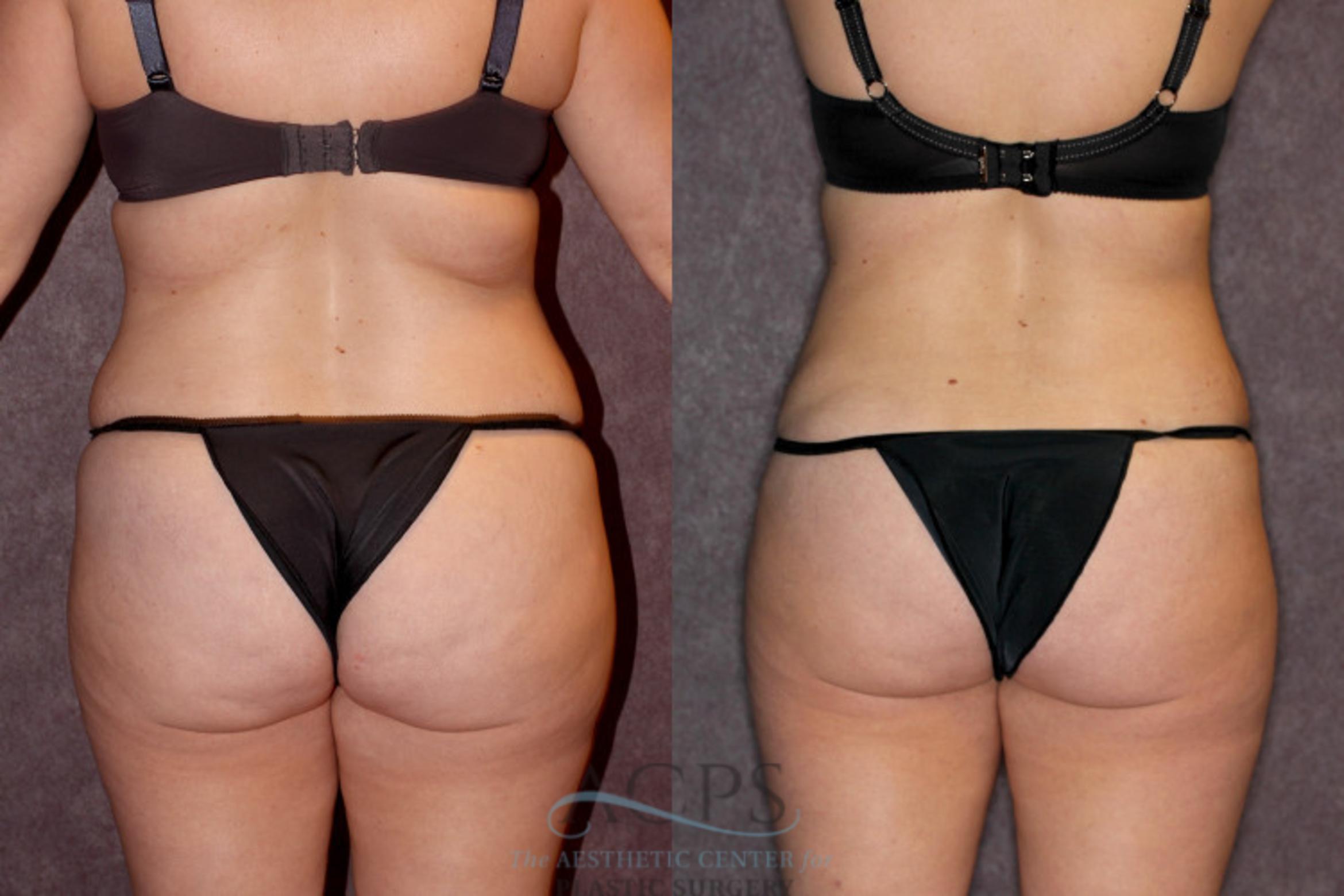 Before & After Tummy Tuck Case 68 Rear View: View in Houston, TX