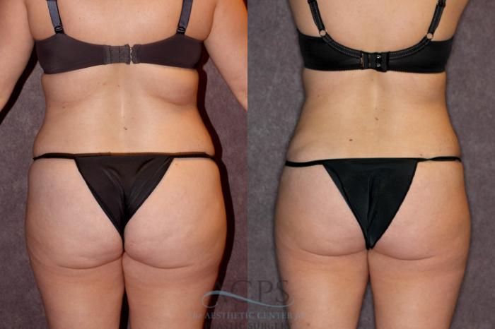 Before & After Tummy Tuck Case 68 Rear View: View in Houston, TX