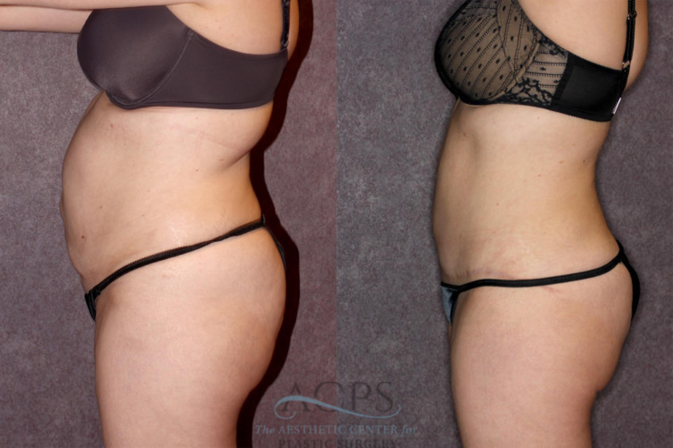 Before & After Tummy Tuck Case 68 Side Left View: View in Houston, TX