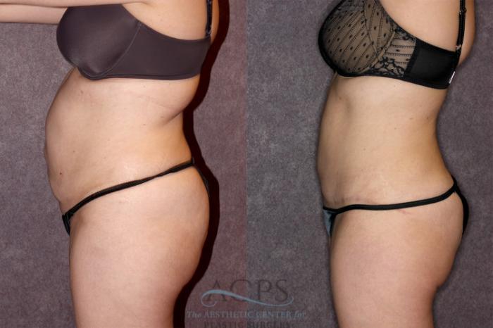 Before & After Tummy Tuck Case 68 Side Left View: View in Houston, TX
