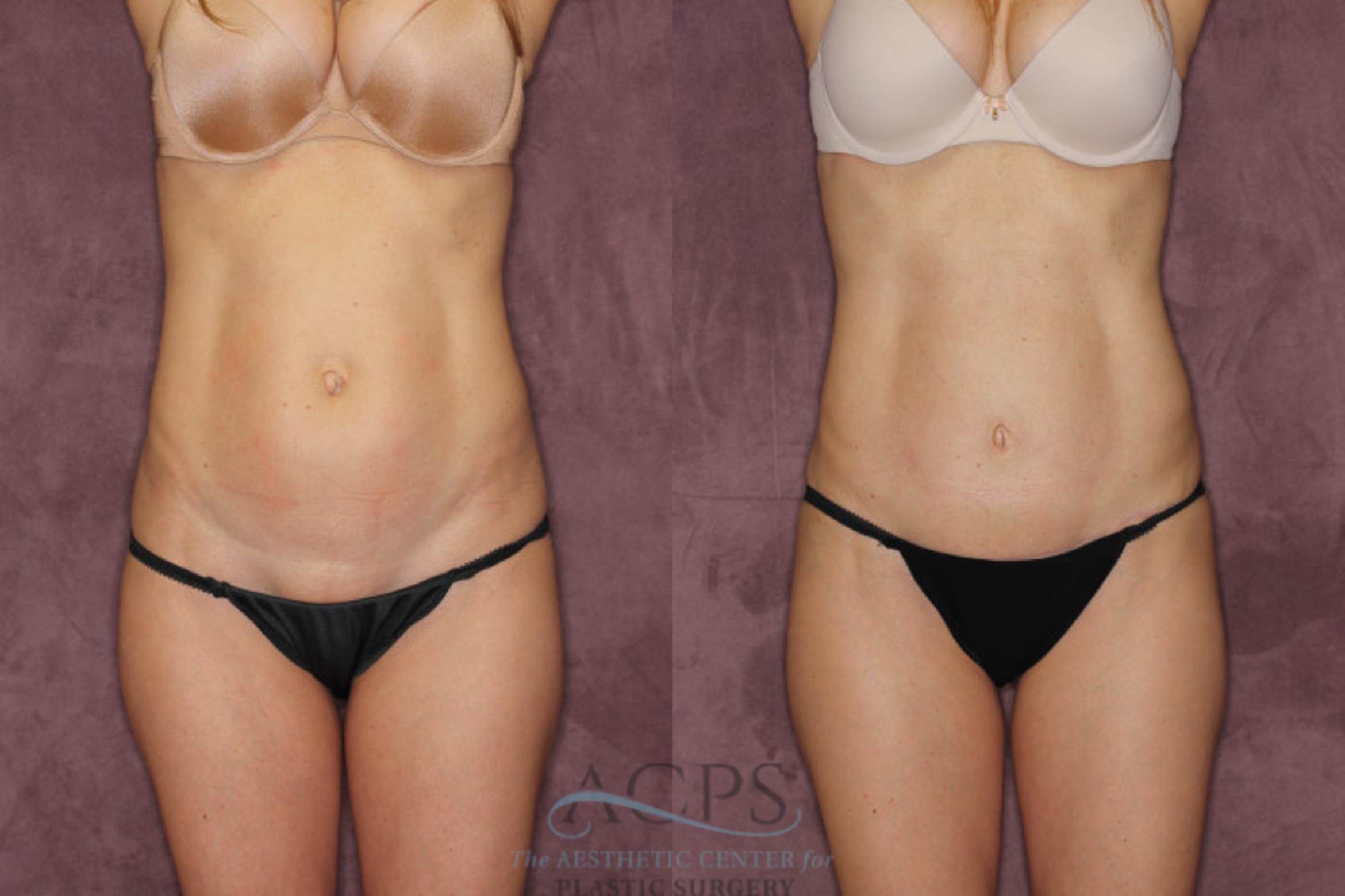 Before & After Tummy Tuck Case 69 Front View: View in Houston, TX