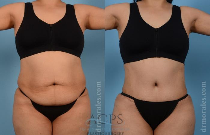 Before & After Tummy Tuck Case 7 Front View: View in Houston, TX