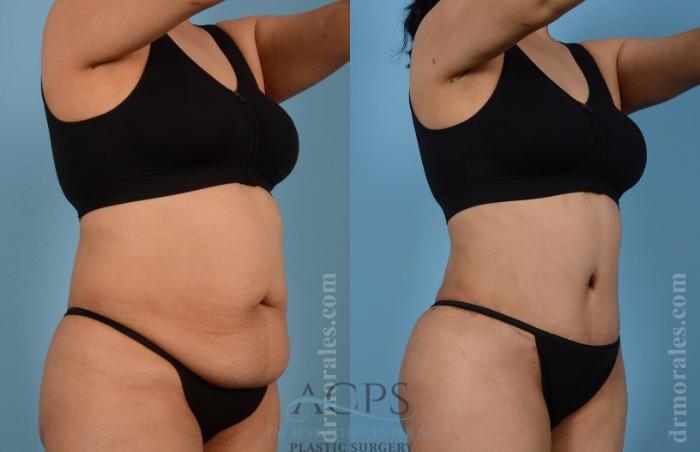 Before & After Tummy Tuck Case 7 Oblique View: View in Houston, TX