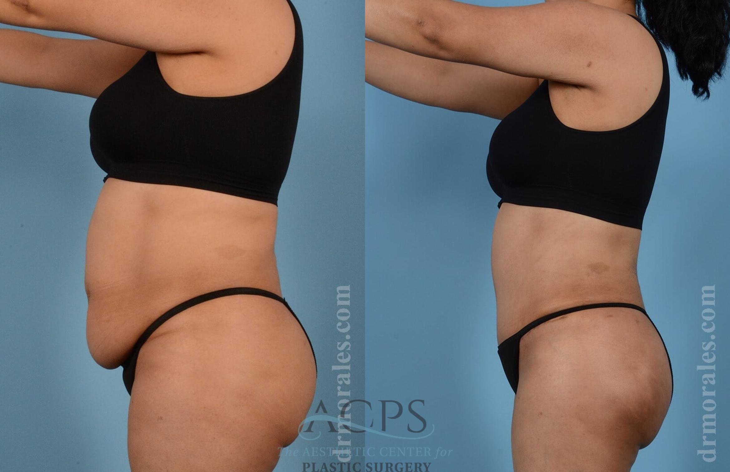 Before & After Tummy Tuck Case 7 Side View: View in Houston, TX