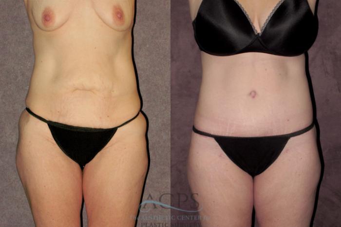 Before & After Tummy Tuck Case 70 Front View: View in Houston, TX