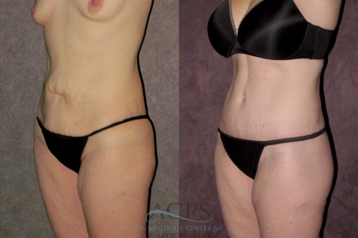 Before & After Tummy Tuck Case 70 Oblique Left View: View in Houston, TX
