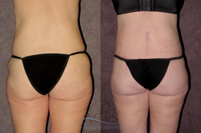 Before & After Tummy Tuck Case 70 Rear View: View in Houston, TX