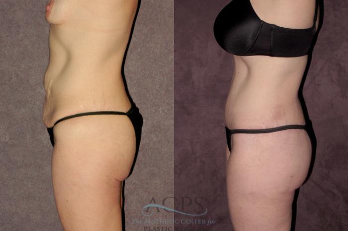 Before & After Tummy Tuck Case 70 Side Left View: View in Houston, TX