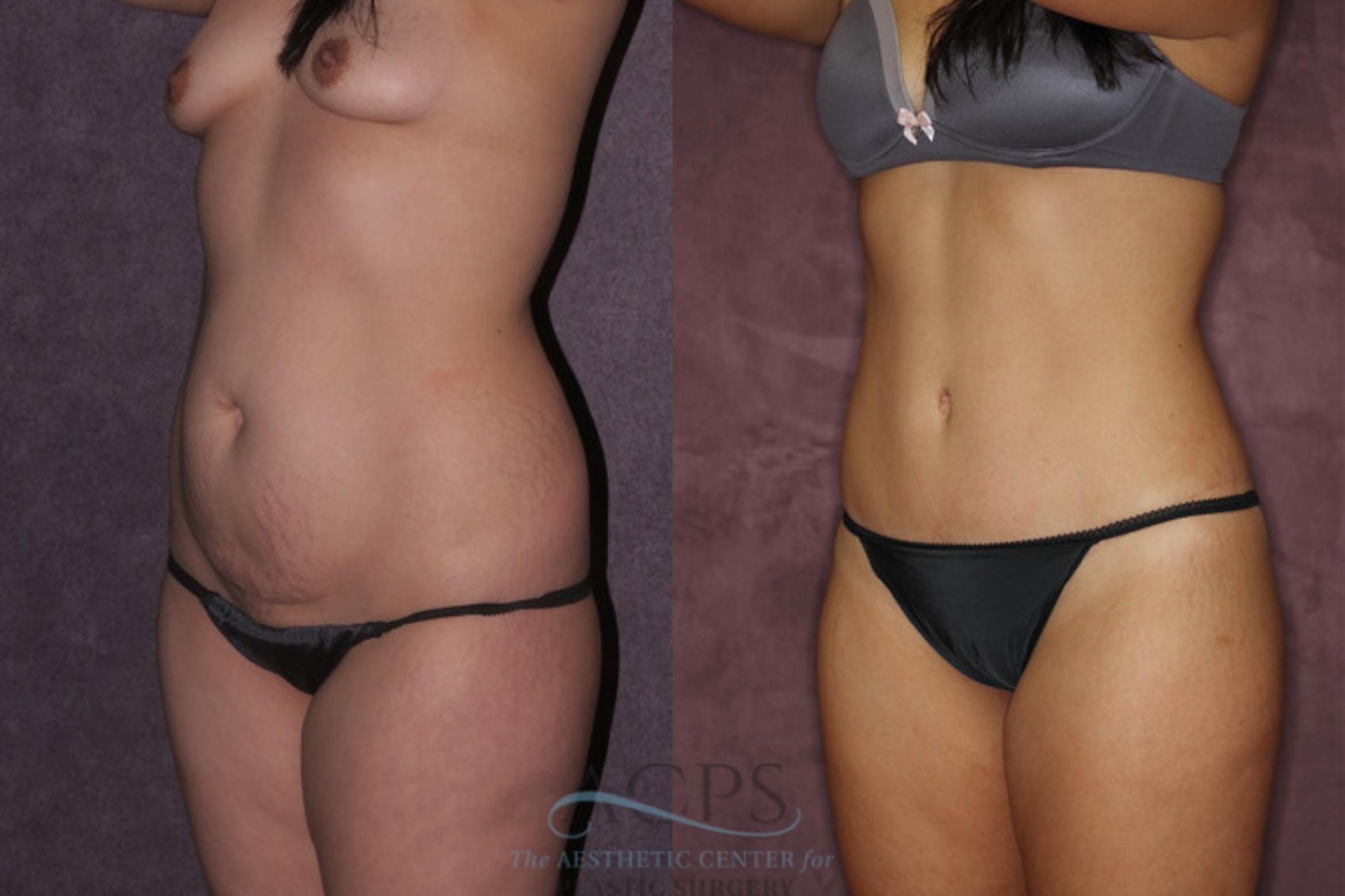 Before & After Tummy Tuck Case 71 Oblique Left View: View in Houston, TX