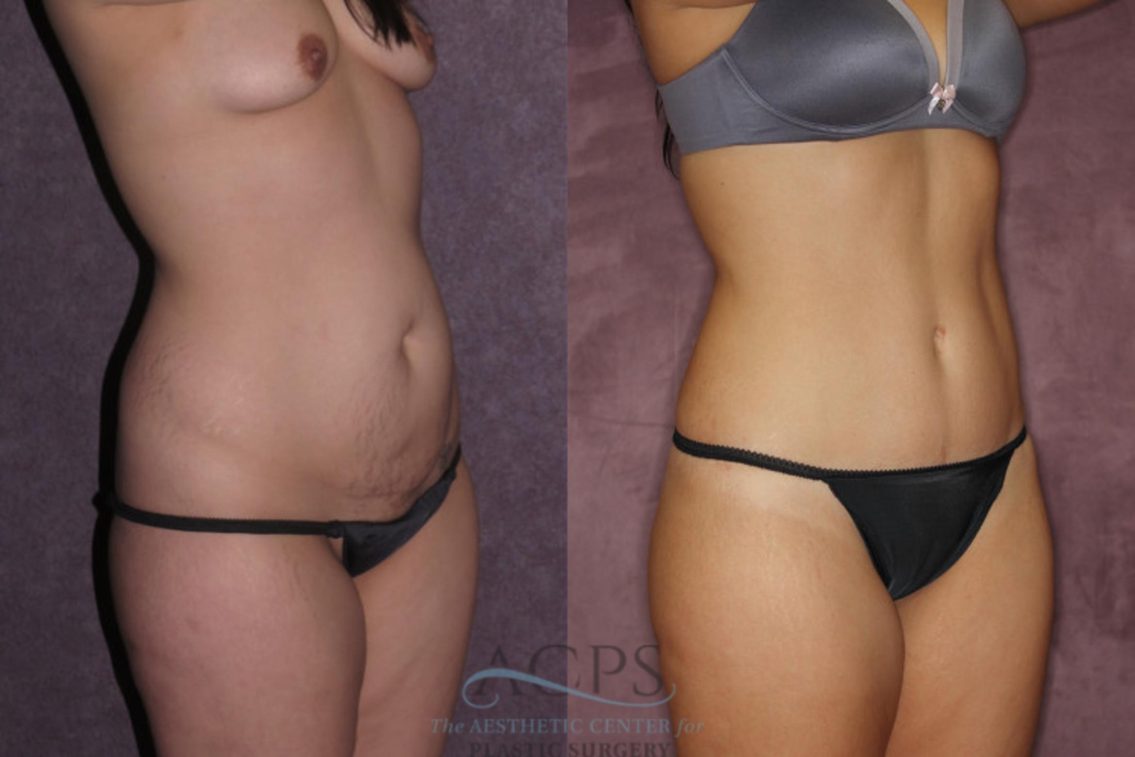 Before & After Tummy Tuck Case 71 Oblique Right View: View in Houston, TX
