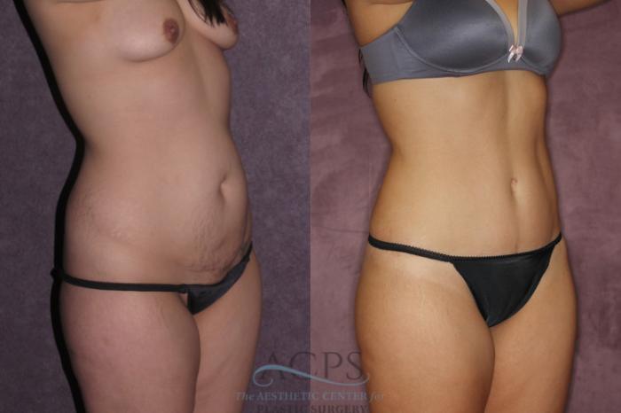Before & After Tummy Tuck Case 71 Oblique Right View: View in Houston, TX