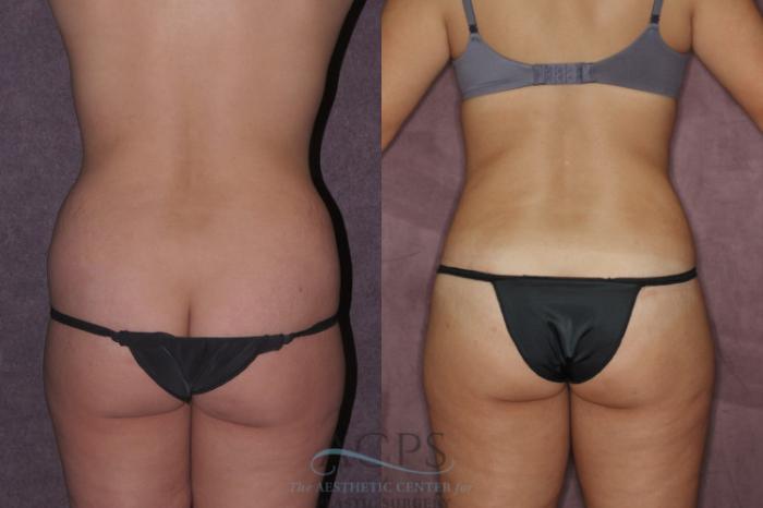 Before & After Tummy Tuck Case 71 Rear View: View in Houston, TX