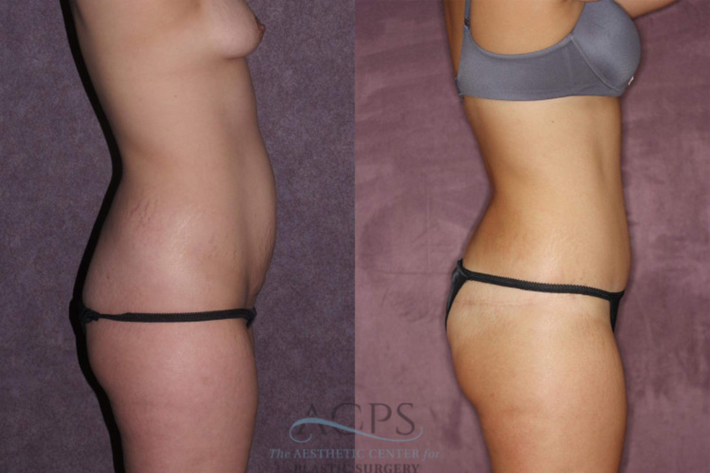 Before & After Tummy Tuck Case 71 Side Right View: View in Houston, TX