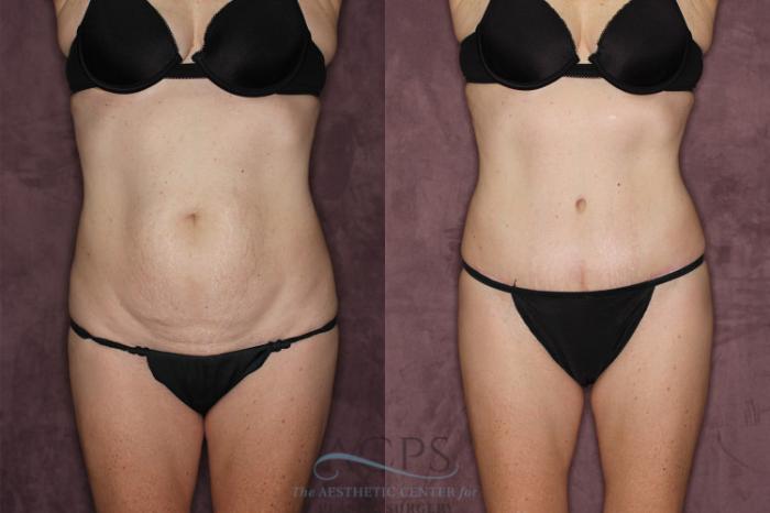 Before & After Tummy Tuck Case 72 Front View: View in Houston, TX