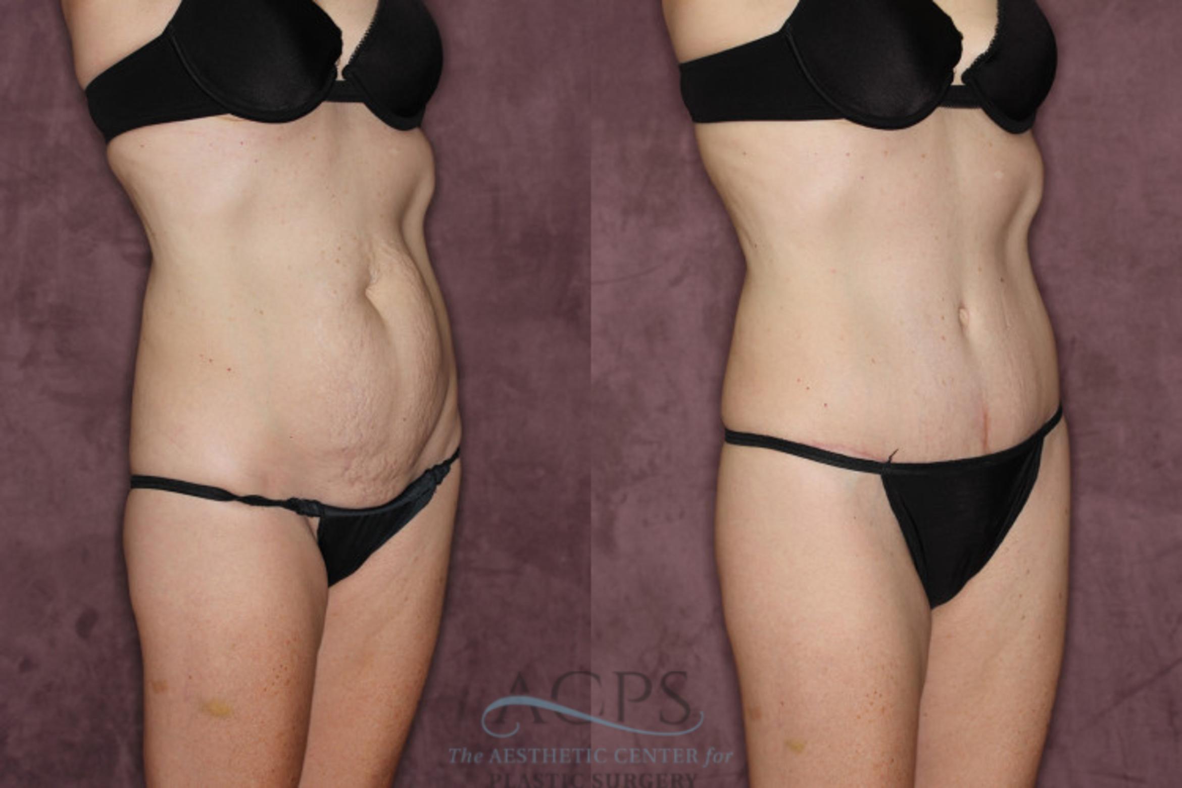 Before & After Tummy Tuck Case 72 Oblique Right View: View in Houston, TX