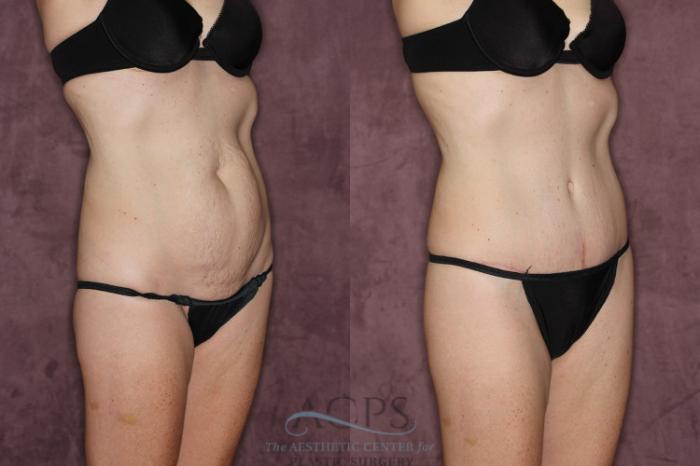 Before & After Tummy Tuck Case 72 Oblique Right View: View in Houston, TX