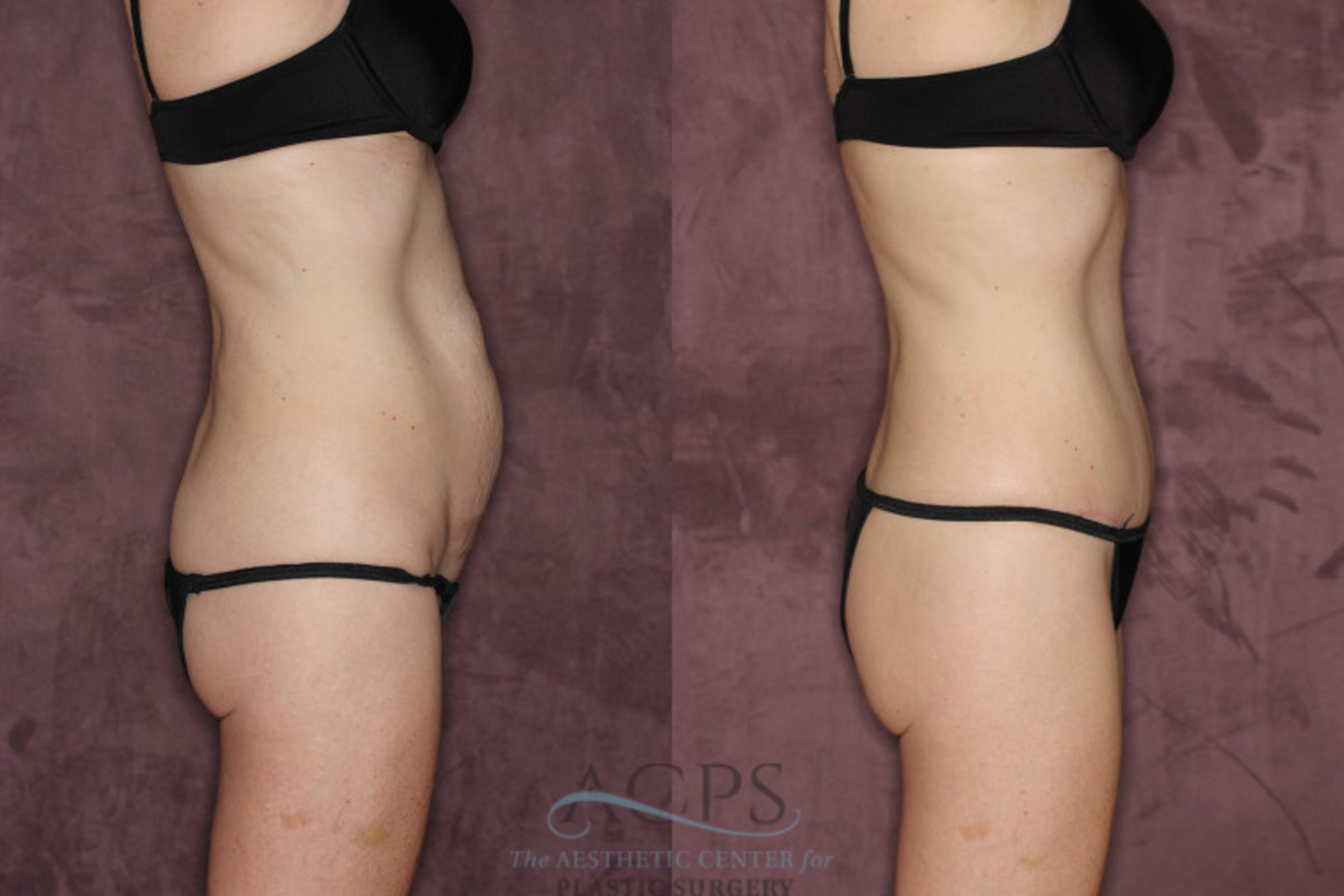 Before & After Tummy Tuck Case 72 Side Right View: View in Houston, TX