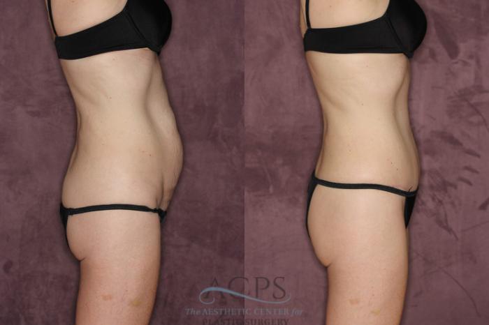 Before & After Tummy Tuck Case 72 Side Right View: View in Houston, TX