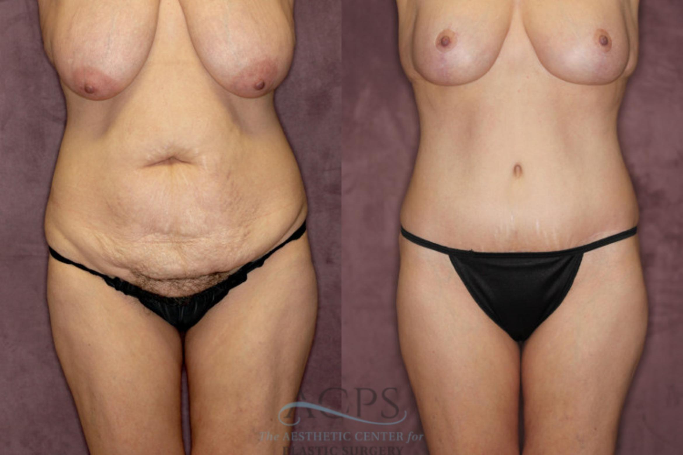 Before & After Tummy Tuck Case 73 Front View: View in Houston, TX