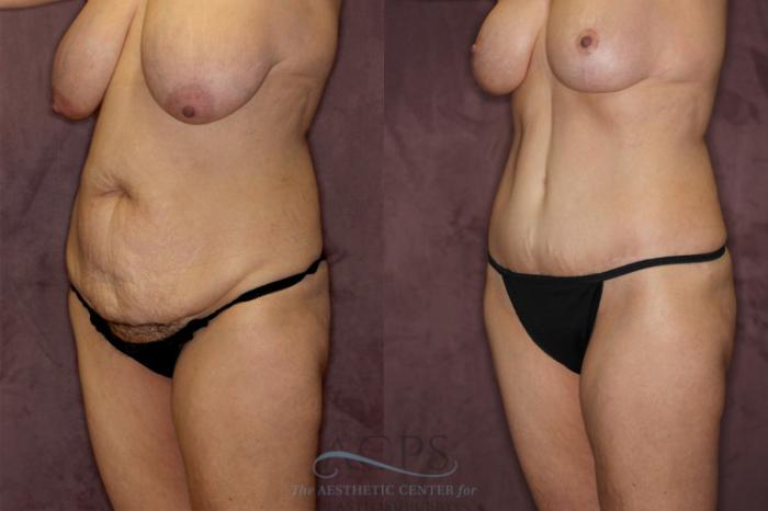 Before & After Tummy Tuck Case 73 Oblique Left View: View in Houston, TX