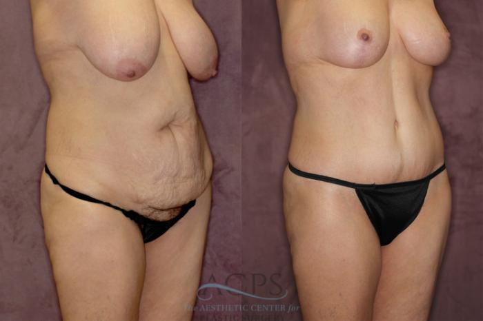 Before & After Tummy Tuck Case 73 Oblique Right View: View in Houston, TX
