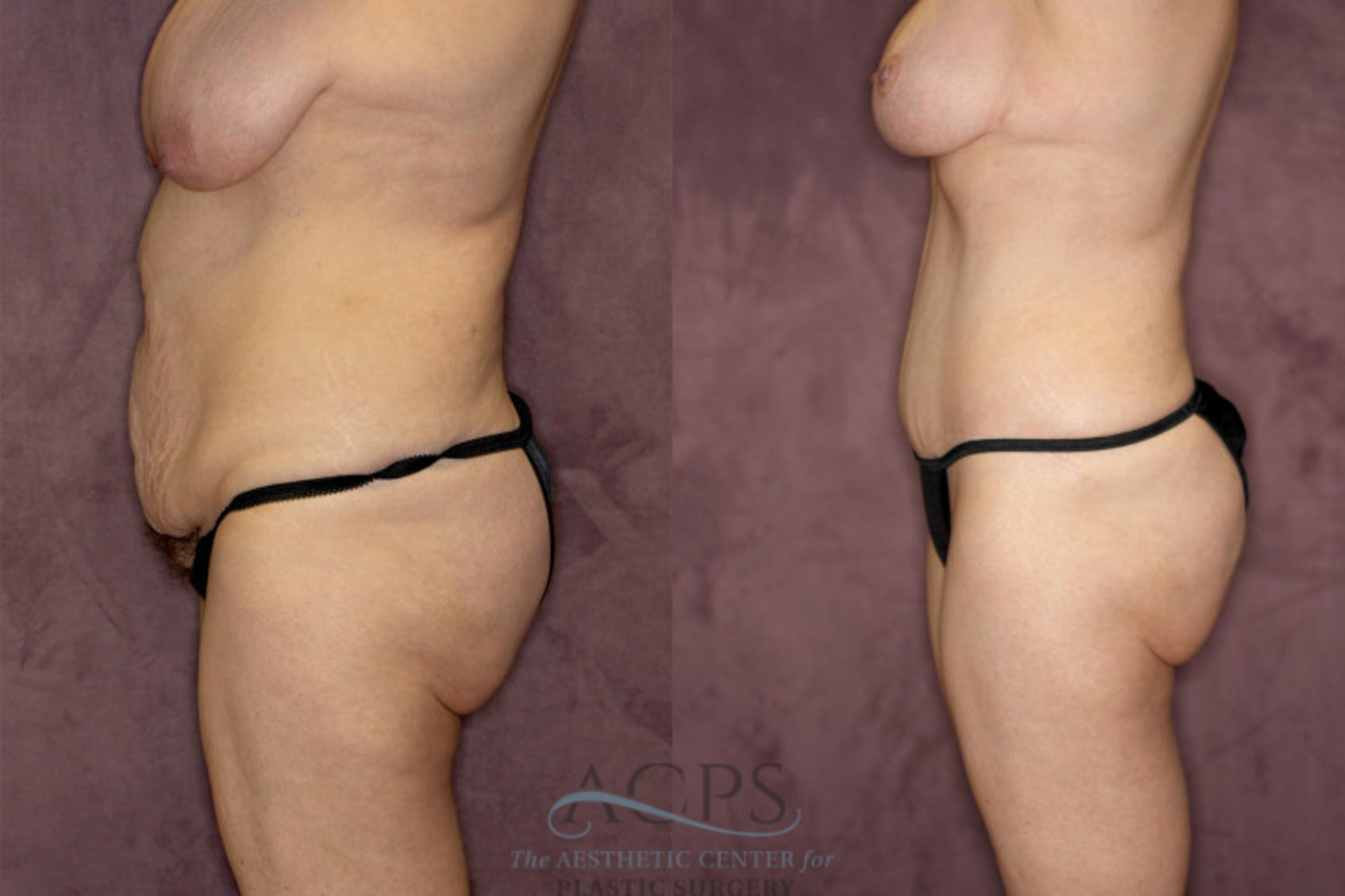 Before & After Tummy Tuck Case 73 Side Left View: View in Houston, TX