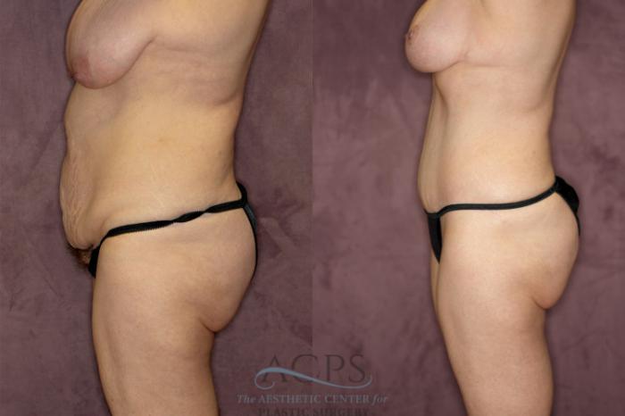 Before & After Tummy Tuck Case 73 Side Left View: View in Houston, TX