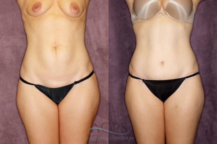 Before & After Tummy Tuck Case 74 Front View: View in Houston, TX