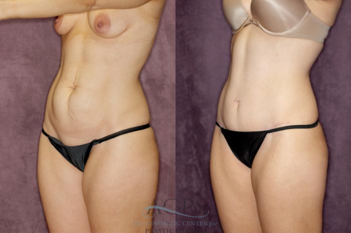 Before & After Tummy Tuck Case 74 Oblique Left View: View in Houston, TX