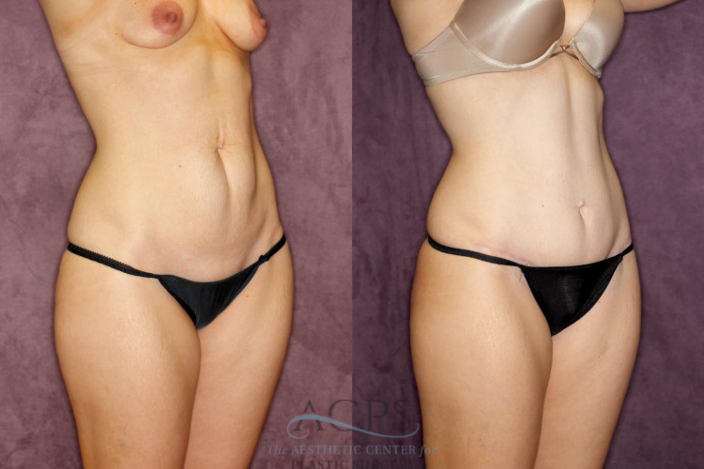 Before & After Tummy Tuck Case 74 Oblique Right View: View in Houston, TX