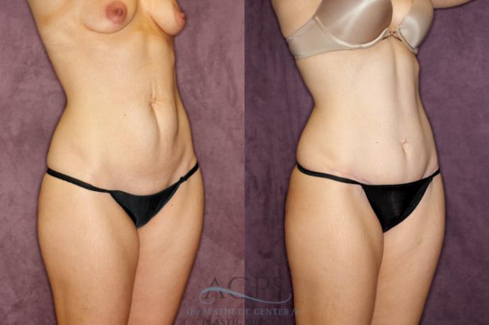 Before & After Tummy Tuck Case 74 Oblique Right View: View in Houston, TX