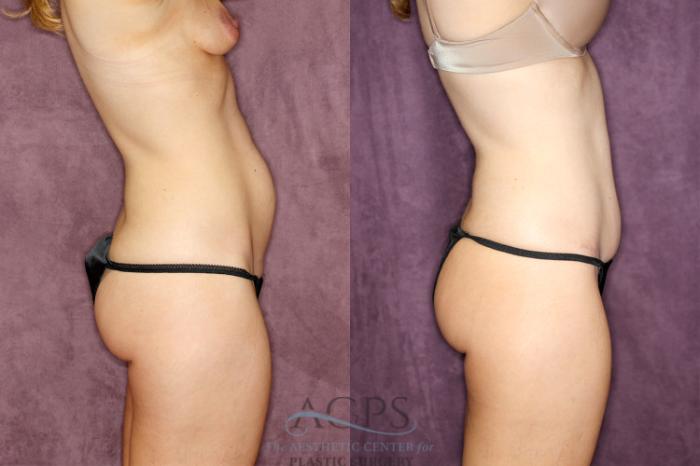 Before & After Tummy Tuck Case 74 Side Right View: View in Houston, TX