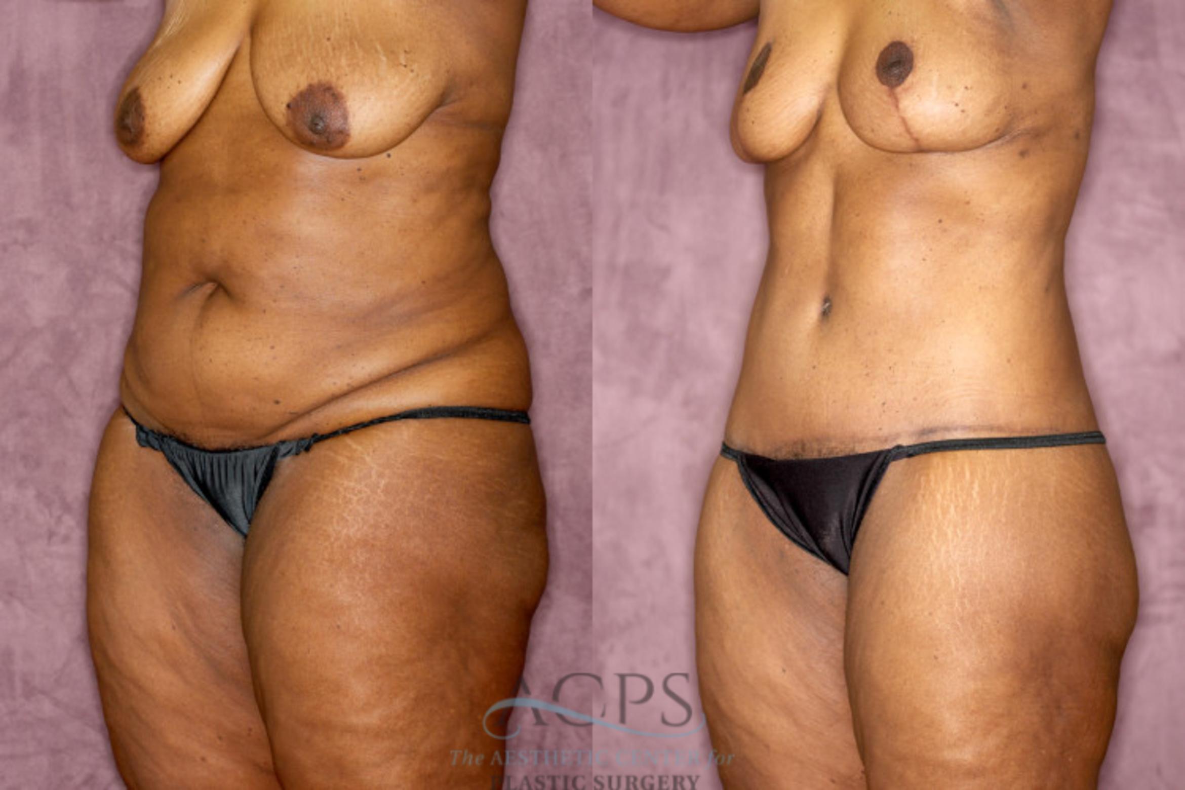Before & After Tummy Tuck Case 75 Oblique Left View: View in Houston, TX