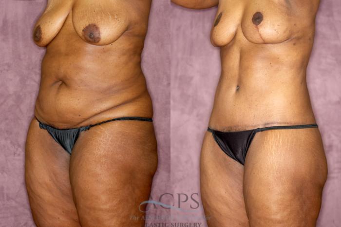 Before & After Tummy Tuck Case 75 Oblique Left View: View in Houston, TX