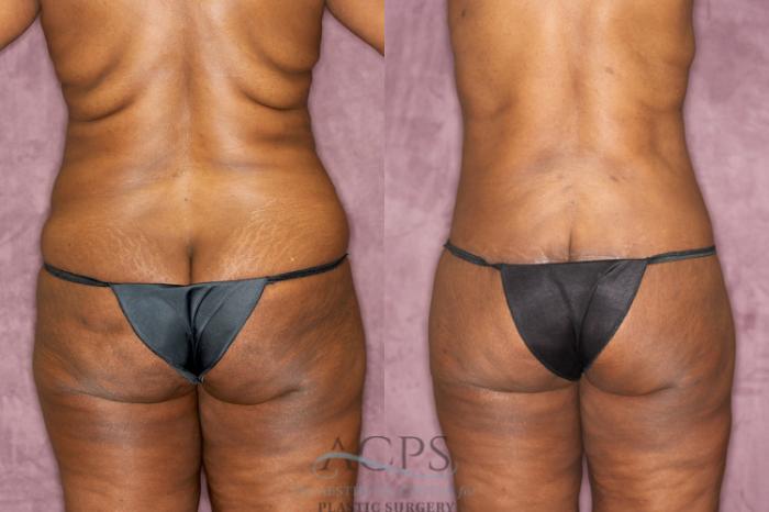 Before & After Tummy Tuck Case 75 Rear View: View in Houston, TX