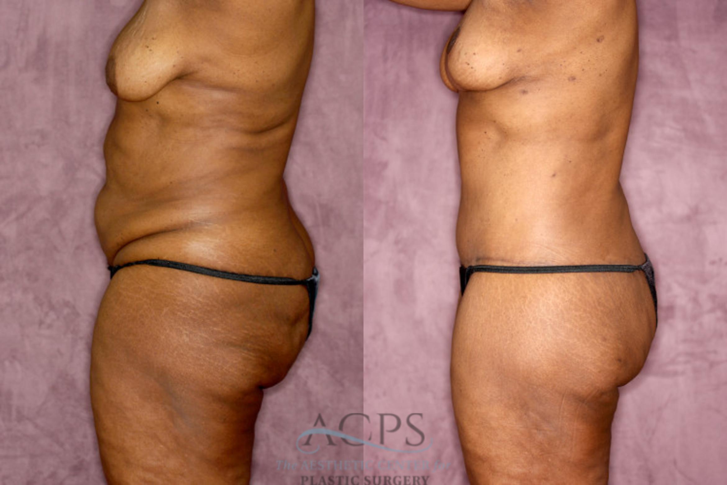 Before & After Tummy Tuck Case 75 Side Left View: View in Houston, TX