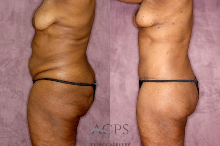 Before & After Tummy Tuck Case 75 Side Left View: View in Houston, TX