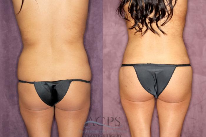 Before & After Tummy Tuck Case 76 Rear View: View in Houston, TX