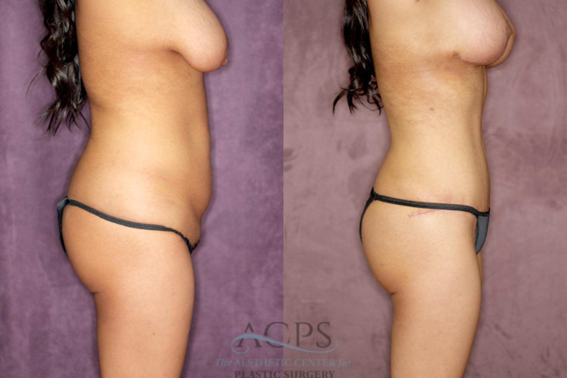 Before & After Tummy Tuck Case 76 Side Right View: View in Houston, TX