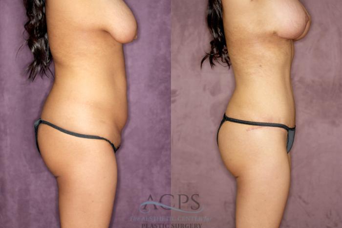 Before & After Tummy Tuck Case 76 Side Right View: View in Houston, TX