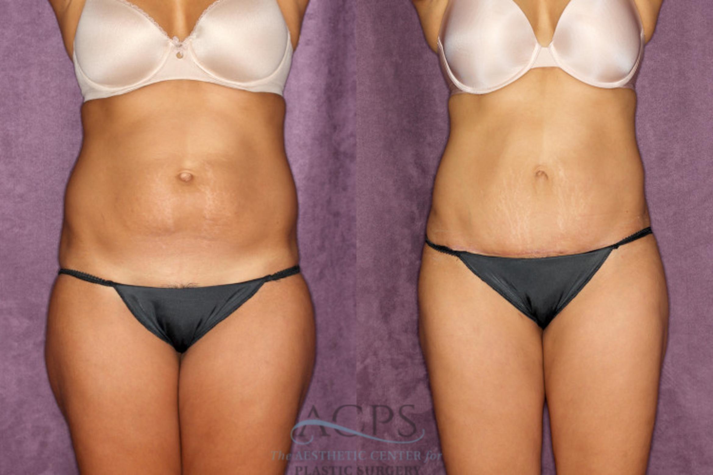 Before & After Tummy Tuck Case 77 Front View: View in Houston, TX