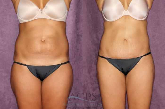 Before & After Tummy Tuck Case 77 Front View: View in Houston, TX