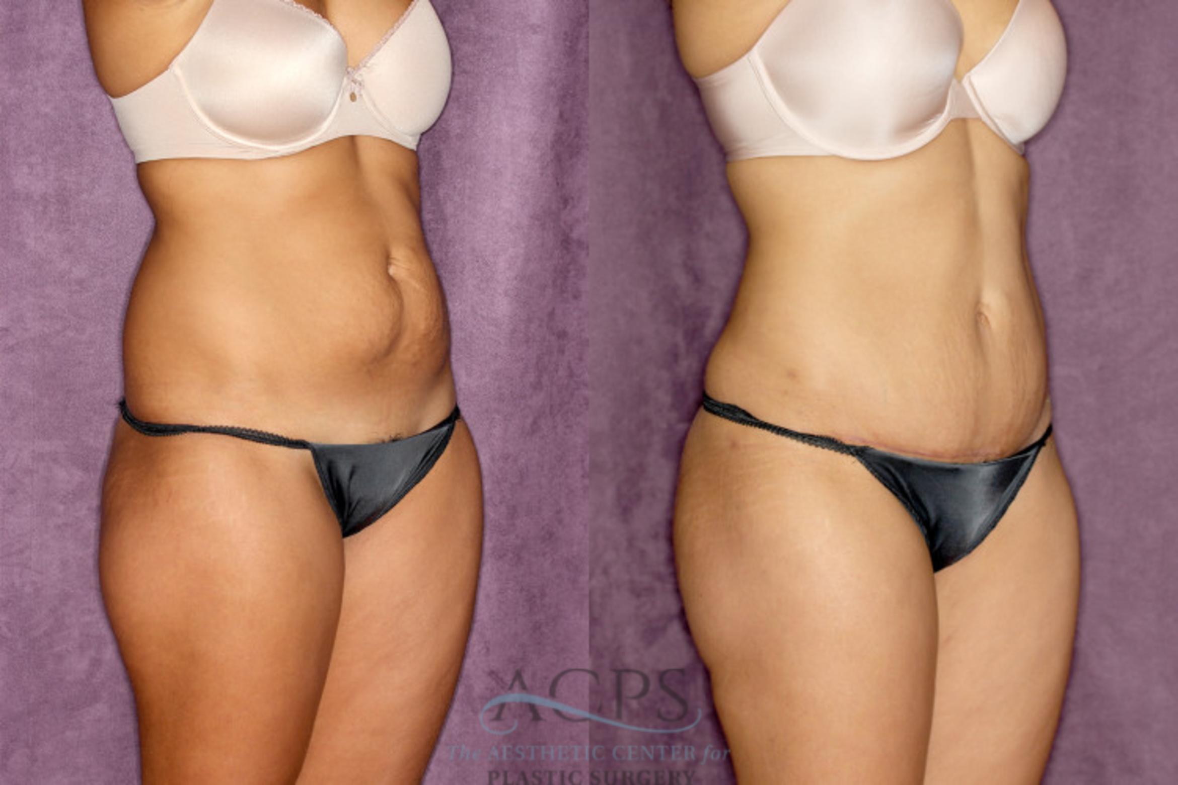 Before & After Tummy Tuck Case 77 Oblique Right View: View in Houston, TX