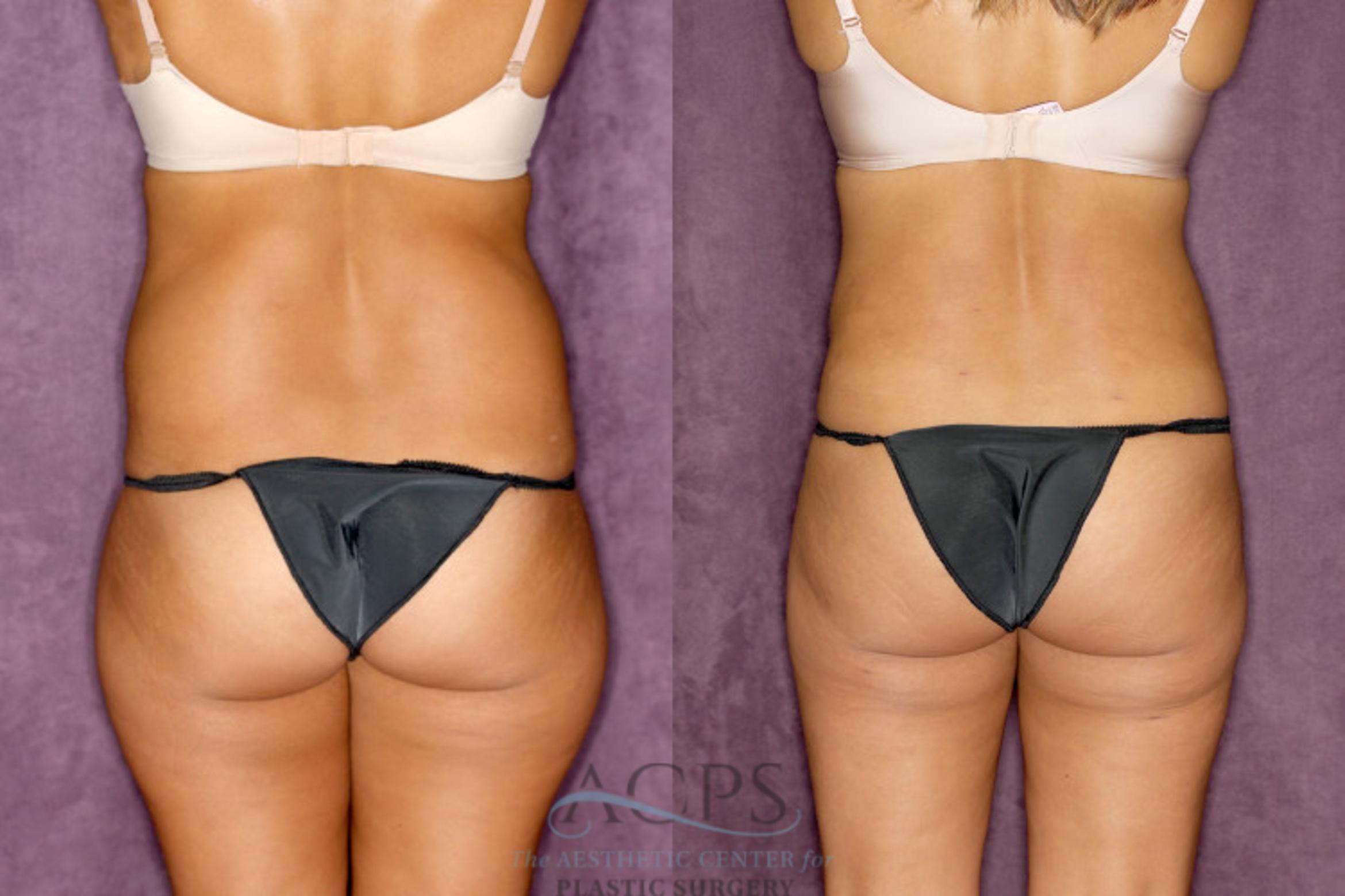 Before & After Tummy Tuck Case 77 Rear View: View in Houston, TX